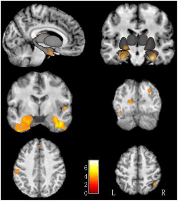 Brain Structural Alterations in Left-Behind Children: A Magnetic Resonance Imaging Study